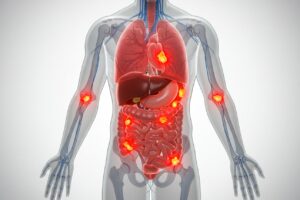 人体の各臓器や関節に炎症が発生しているイメージ図。老化に伴う慢性炎症を示すビジュアル